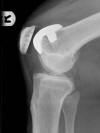 Intra-articular Dislocation Of Patella Following Patellofemoral 