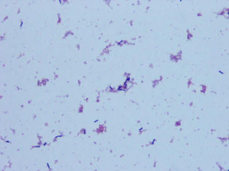 Pyelonephritis And Bacteremia From Lactobacillus Acidophilus 