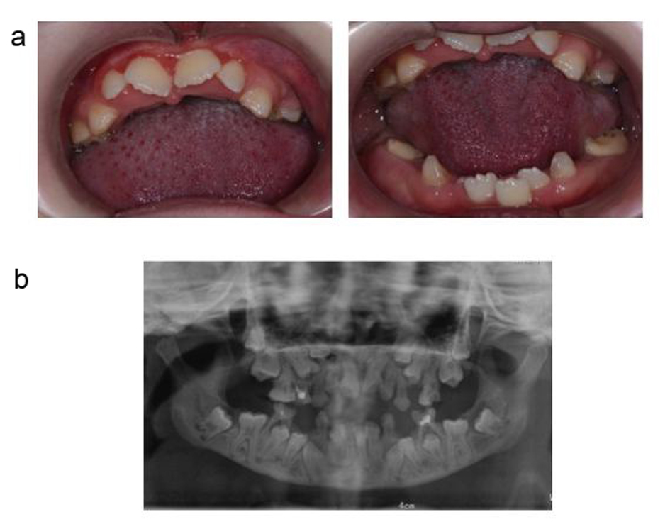 Delayed Eruption Of Permanent Teeth In An Adolescent With Down s 