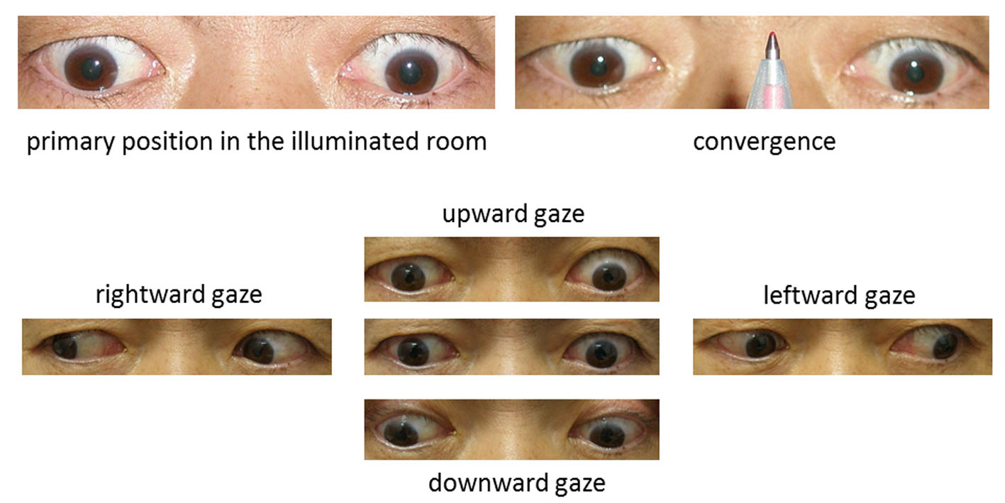 conjugate vertical gaze