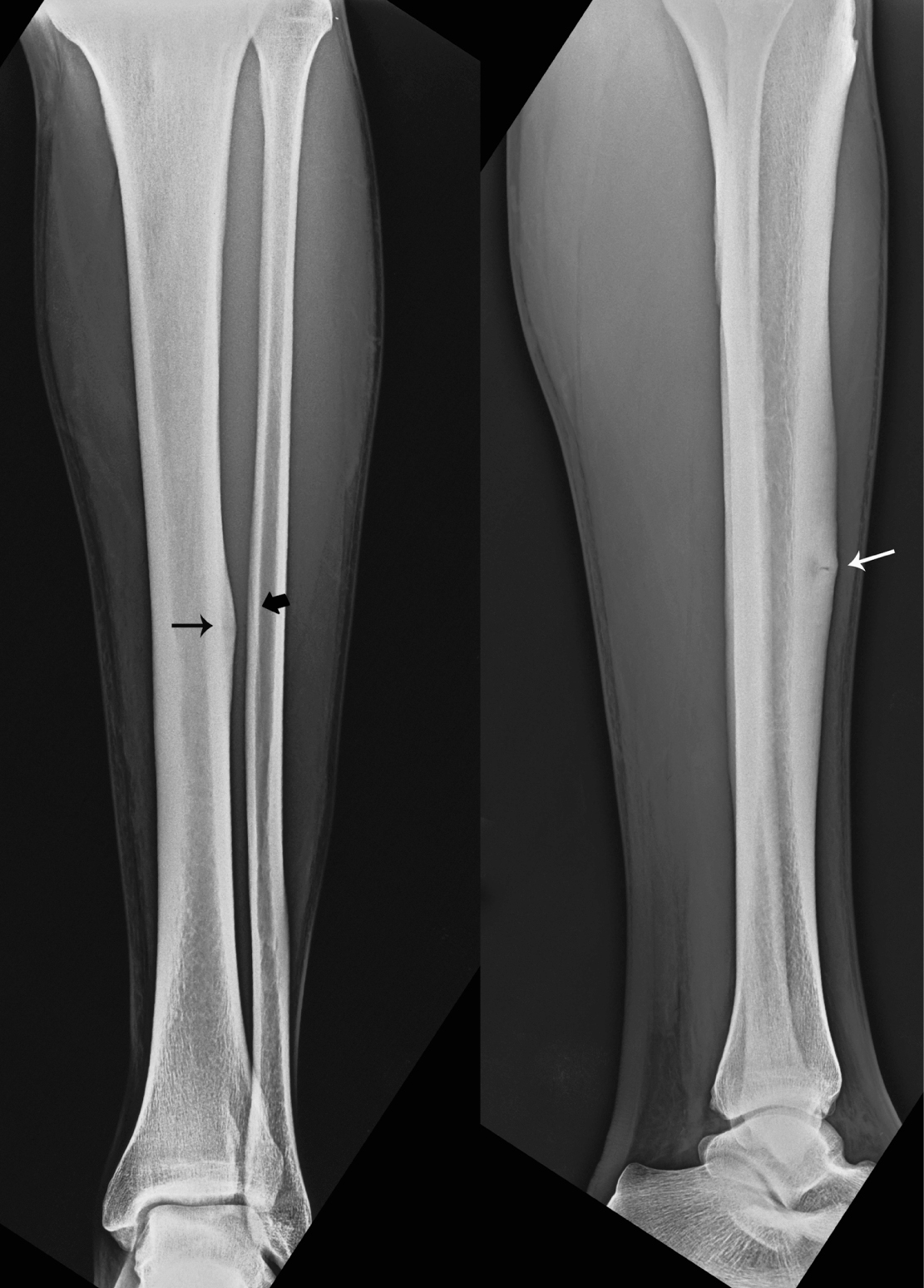 Anterior Tibial Cortex Stress Fracture In A High Demand Professional 