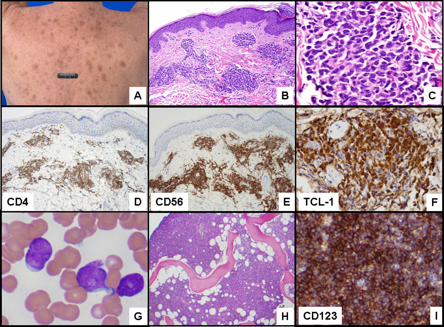 Blastic Plasmacytoid Dendritic Cell Neoplasm With Leukemic Progression