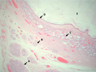 Epidermoid Cyst of the Testis Misdiagnosed as a Hydrocele: A Case ...