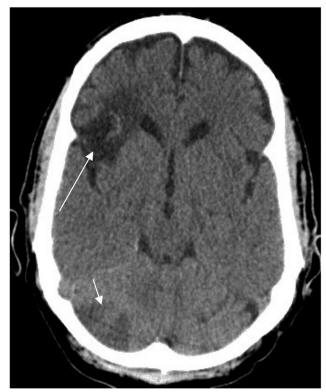 Tumor Embolism Presenting as Rapidly-forming Cavitary Lesion | Sweigart ...