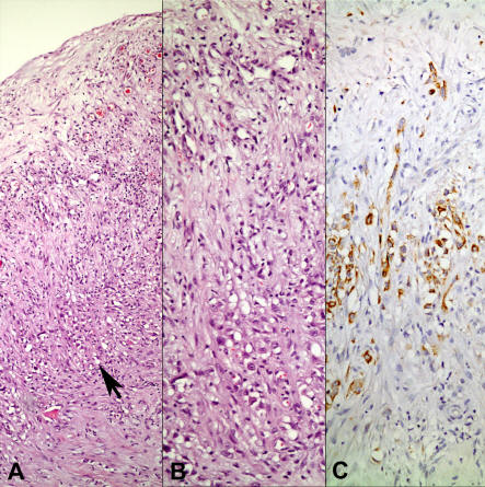 Hydrocele and Unexpected Diagnosis: Malignant Mesothelioma of Tunica ...