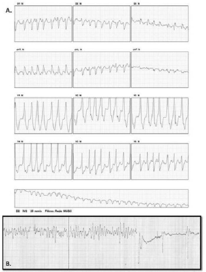 Ventricular Fibrillation During Amiodarone Infusion in a Patient With ...