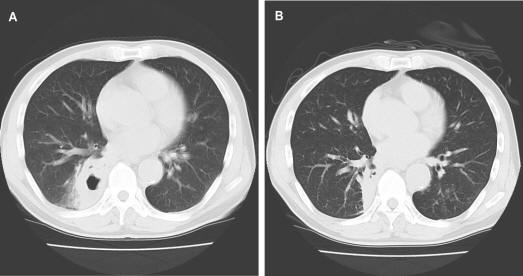 Three Cases With a Lung Abscess and Bronchial Inflammatory Polyps ...