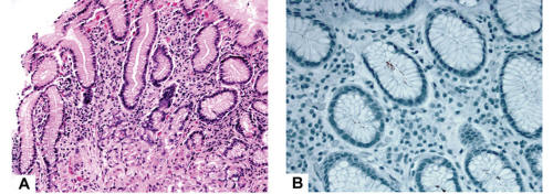 Isolated Russell Body Duodenitis with Concurrent Helicobacter Pylori ...