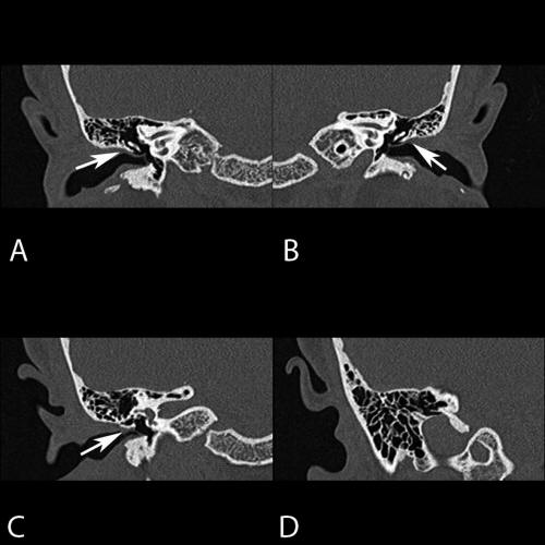 A Scutum Presenting as a White Mass Behind an Intact Tympanic Membrane ...