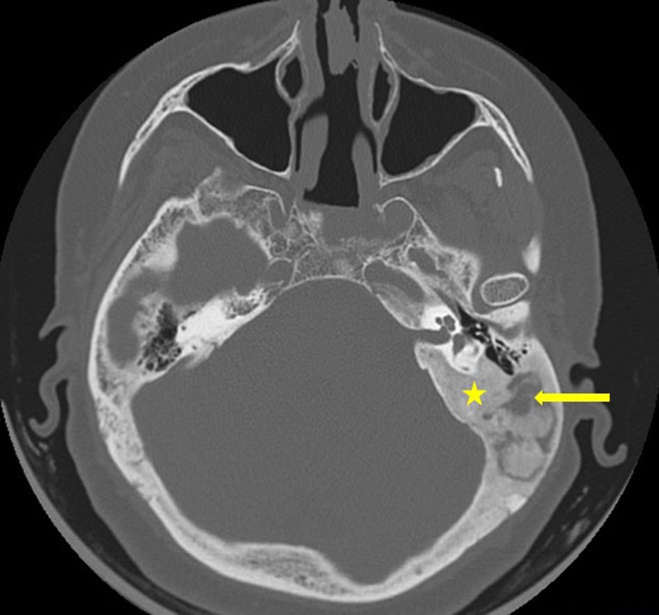 Monostotic Fibrous Dysplasia of the Temporal Bone: A Case Report and